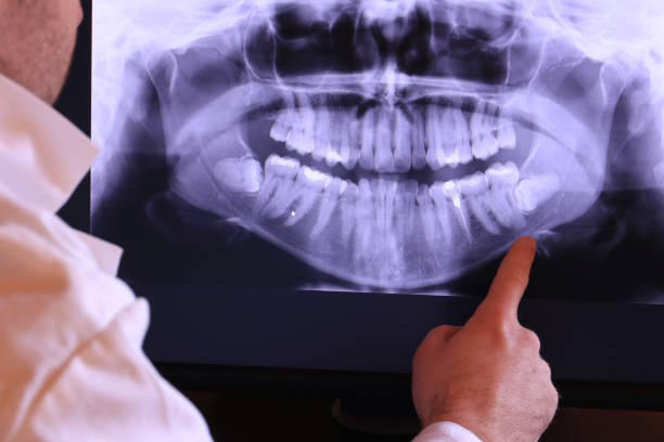 Best Emergency Wisdom Teeth Removal in Highlands, CA